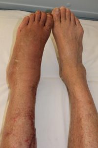 Did you know that varicose veins can also lead to foot pain?